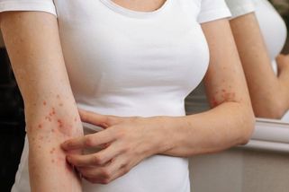 Případů svrabu je letos více než 7100. O skoro polovinu víc než loni za pololetí - Seznam Zprávy
