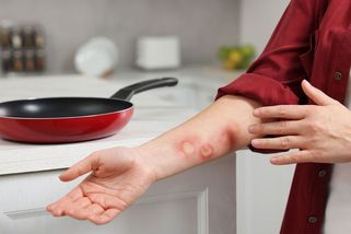 Popáleniny mohou být vážnější, než vypadají. Jak je správně ošetřit a co nikdy nedělat - Proženy.cz