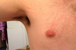 V Česku řádí největší epidemie svrabu za posledníc...