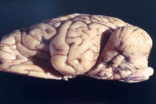 Umírání za otřesů chechotu - děsivá nemoc kuru způsobená kanibalismem - Médium.cz
