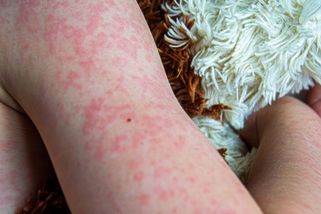 Jihočeským krajem se šíří spalničky. Nakažených přibývá hlavně mezi neočkovanými - Novinky