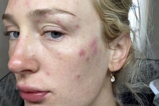 Takhle se dva dny před svatbou probudit nechcete! Nevěstu tak poštípali komáři, že prosila fotografa o Photoshop - Super.cz