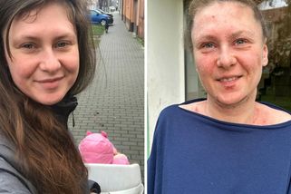 Nemůže bolestí spát, vyjít ven ani pohladit dcerku. Renatě ničí život nemoc kůže! Léčba zatím není - Proženy.cz