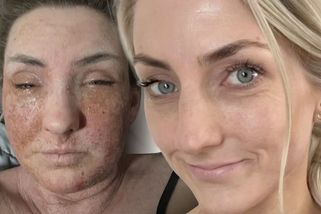 Po třiceti letech vysadila krém na ekzém. Co následovalo, ji málem dohnalo k sebevraždě