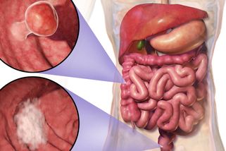 Oblíbené potraviny Čechů pomáhají podle studie vědců přiživovat rakovinu - Médium.cz