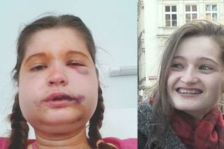 Kristýna žije již 18 let s rovnátky. Úlevu by jí přinesla operace, tu ale pojišťovna nehradí - Novinky