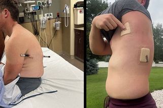 Američan se na túře propíchl trekingovou holí. S tyčí v těle ušel za záchranou 16 kilometrů - Novinky