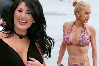 První transgender vítězka Big Brothera šokovala na pláži po faceliftu. Po shození půl metráku na ní visí kůže