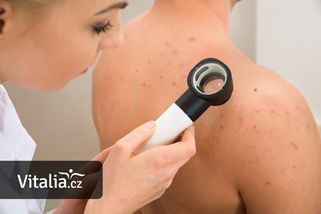 Lékaři zdarma vyšetří znaménka. Stany proti melanomu vyrostou po celém Česku