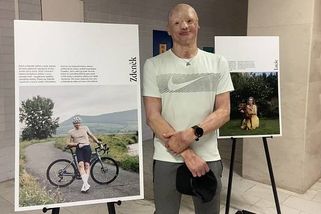 Zdeněk utrpěl popáleniny v obličeji, ztratil nos. V Brně mu teď modelují obličej