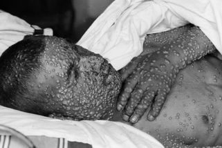 Na tu nemoc umíraly miliony. Sloužila jako biologická zbraň. Než přišla vakcína - Seznam Zprávy