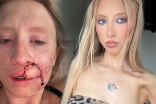 Dívce s tváří anděla se kamarádčin obří pes zakousl do obličeje. Můj život skončil, pomyslela si, když se viděla v zrcadle - Super.cz